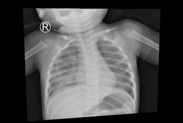 Bé trai bị viêm phổi, suy hô hấp vì uống dầu thắp đèn ảnh 1