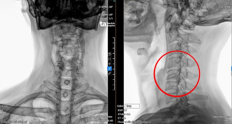 Tổn thương đốt sống cổ vì sử dụng điện thoại quá nhiều ảnh 1