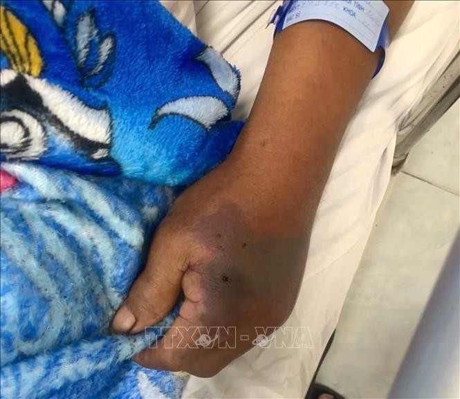 Tiêm 18 lọ huyết thanh cứu cụ ông bị rắn hổ đất cắn ảnh 1