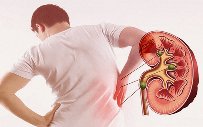 Bệnh sỏi thận và những biến chứng nguy hiểm không thể chủ quan ảnh 1