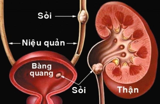 Bệnh sỏi thận và những biến chứng nguy hiểm không thể chủ quan ảnh 2