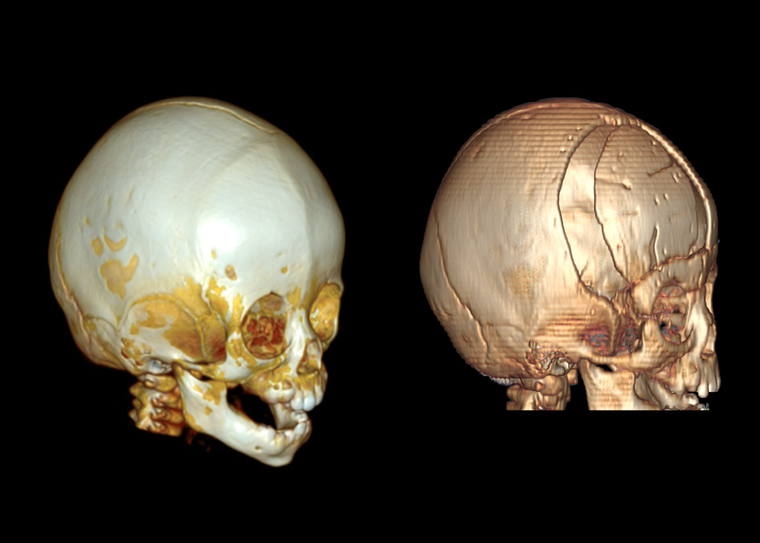 Vinmec phẫu thuật tạo hình hộp sọ thành công cho bệnh nhi 10 tháng tuổi mắc dị tật hiếm gặp ảnh 2