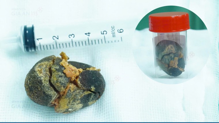 Bác sĩ cảnh báo nguy cơ sỏi túi mật từ thói quen ăn uống không hợp lý ảnh 2