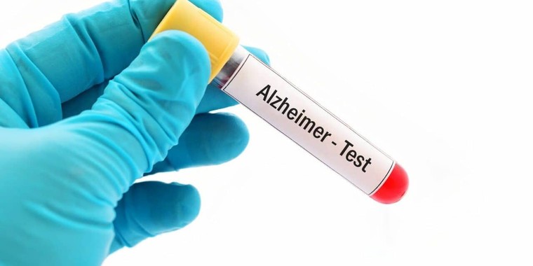 Bộ xét nghiệm máu mới giúp phát hiện sớm bệnh Alzheimer ảnh 1