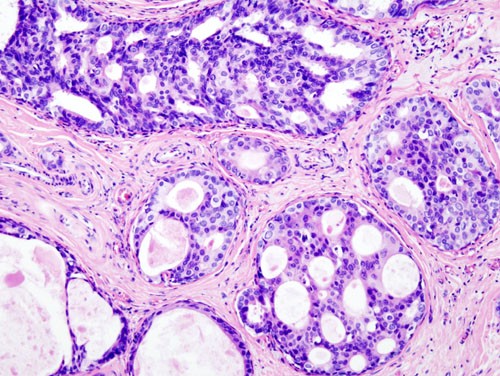 Xét nghiệm gen đột phá có thể giúp hàng triệu phụ nữ ung thư vú không cần hóa trị ảnh 2