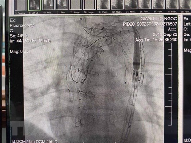 Kết quả can thiệp đặt stent graft động mạch chủ của bệnh nhân. (Ảnh: Mai Trang/TTXVN)