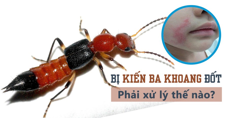 Lời khuyên của bác sĩ khi bị kiến ba khoang đốt