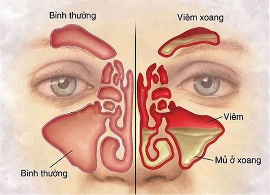 Hình ảnh minh hoạ bệnh viêm xoang.