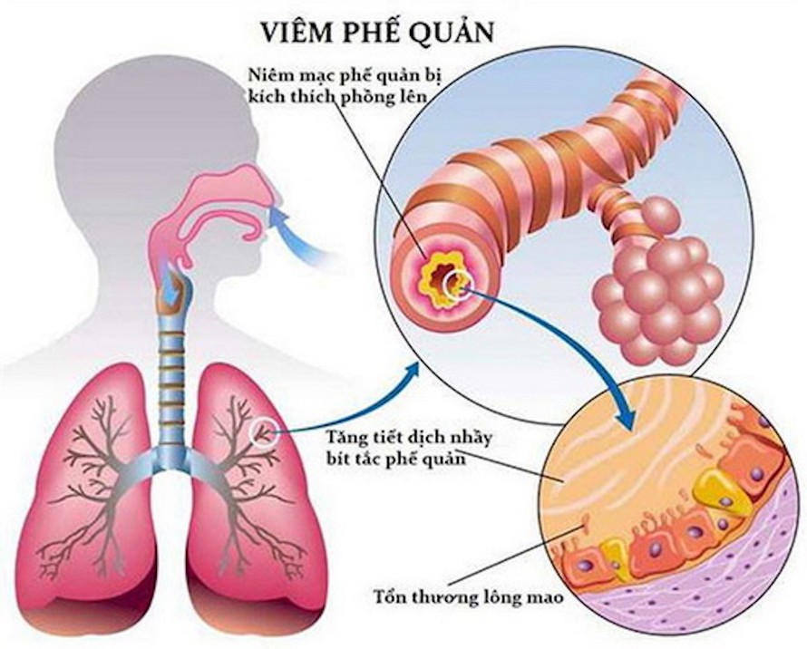 VPQ là bệnh rất thường gặp ở mọi lứa tuổi.