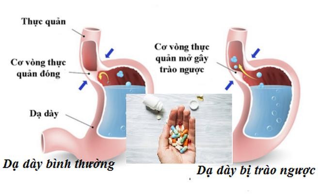 Trào ngược dạ dày - thực quản. (Ảnh: Sức khoẻ & Đời sống)