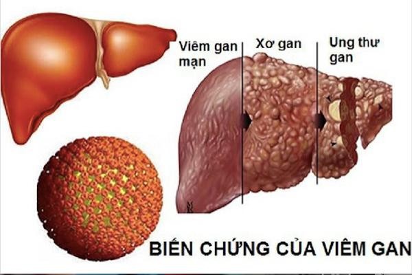 Viêm gan B diễn tiến rất âm thầm, là nguyên nhân hàng đầu gây xơ gan, ung thư gan.