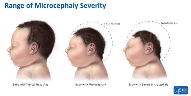 Zika gây dị tật đầu nhỏ ở thai nhi. Ảnh: CDC.