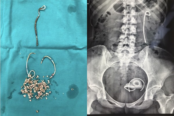 3 đoạn stent được lấy ra kèm theo nhiều sỏi bàng quang