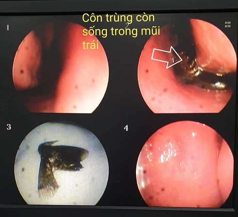 Hình ảnh con bướm bay vào mũi bệnh nhân.