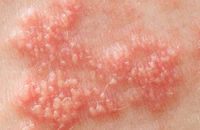 Nghiên cứu về nguồn gốc căn bệnh viêm da phổ biến do nhiễm virus herpes