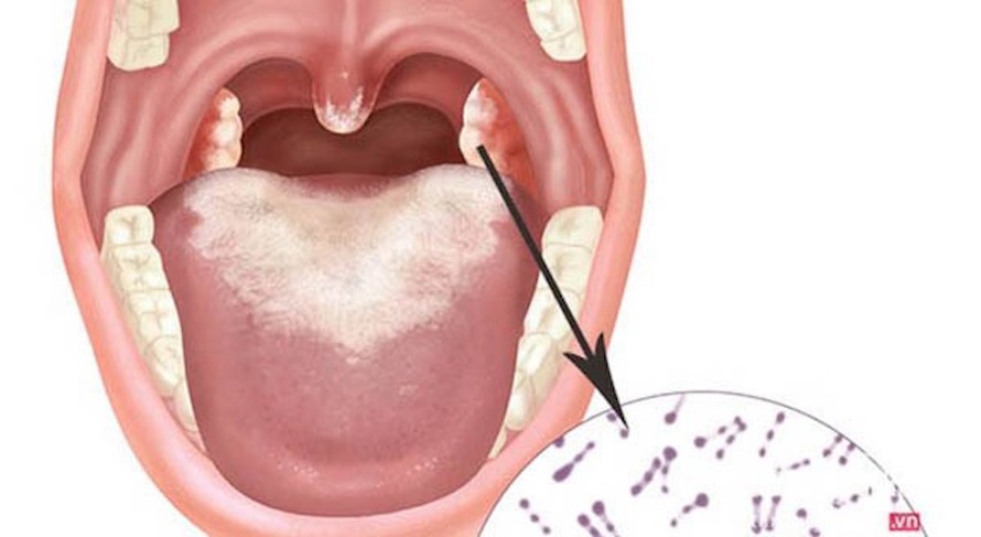 Bệnh bạch hầu có thể gây hậu quả nghiêm trọng nếu không được phát hiện và điều trị kịp thời.