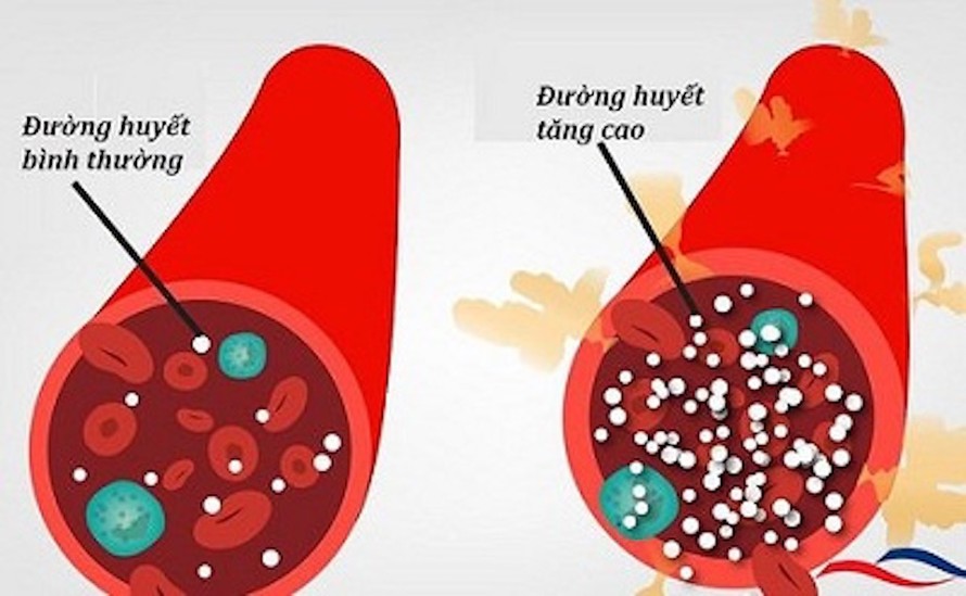 Kích hoạt đường huyết cao làm tăng nguy cơ tử vong ở bệnh nhân COVID-19