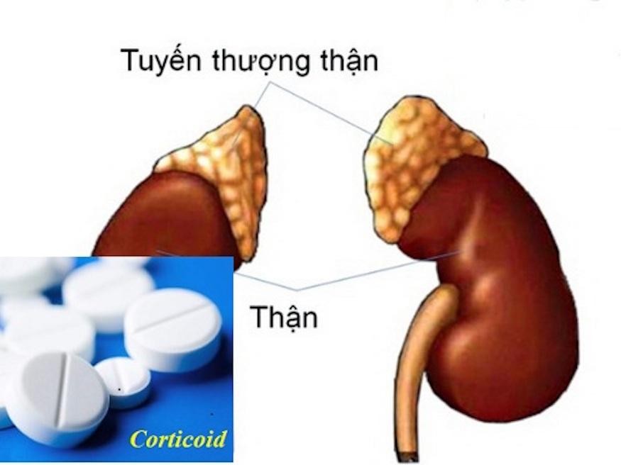 Suy tuyến thượng thận - một tai biến nguy hiểm khi dùng corticoid