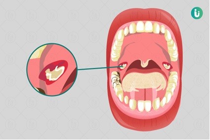 Khẩn trương giám sát, phát hiện sớm, xử lý triệt để ổ bệnh bạch hầu