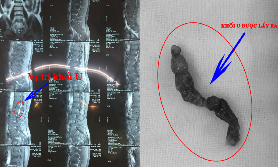 Khối U nằm trong tủy sống bệnh nhân - Ảnh: VTC News