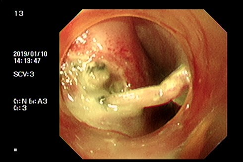 Hình ảnh xương gà găm vào thực quản qua nội soi.