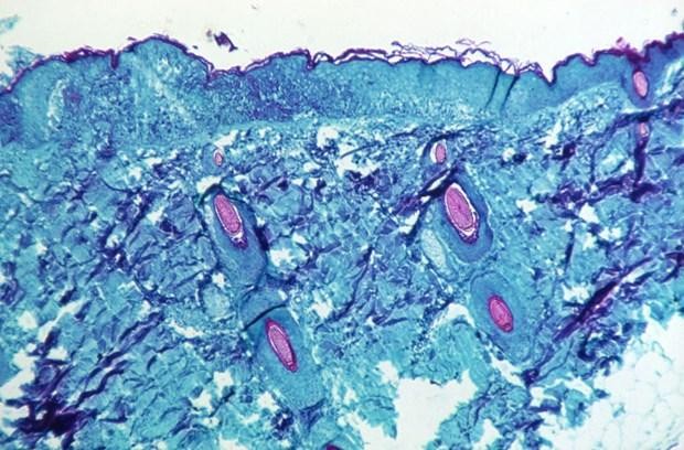 Một phần tế bào da của một con khỉ bị mắc bệnh đậu mùa khỉ. (Ảnh: REUTER/TTXVN)