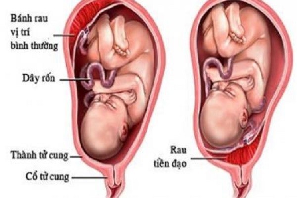 Dây rốn quấn cổ có thể khiến cướp sinh mạng bé khi chưa chào đời