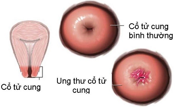 Ung thư cổ tử cung và 'tất tật' những điều cần biết