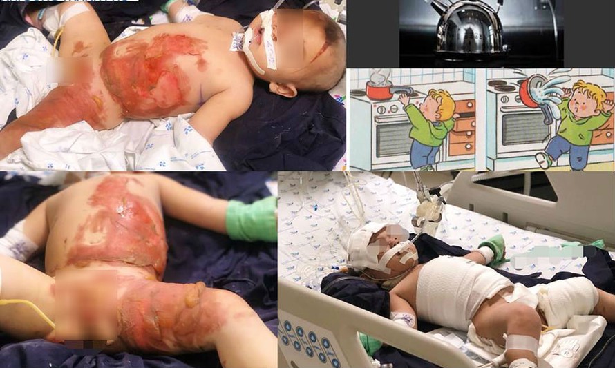 Bé 20 tháng bị bỏng toàn thân do ấm nước sôi dội vào người