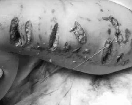 Bệnh nhi bị chó pitbull cắn