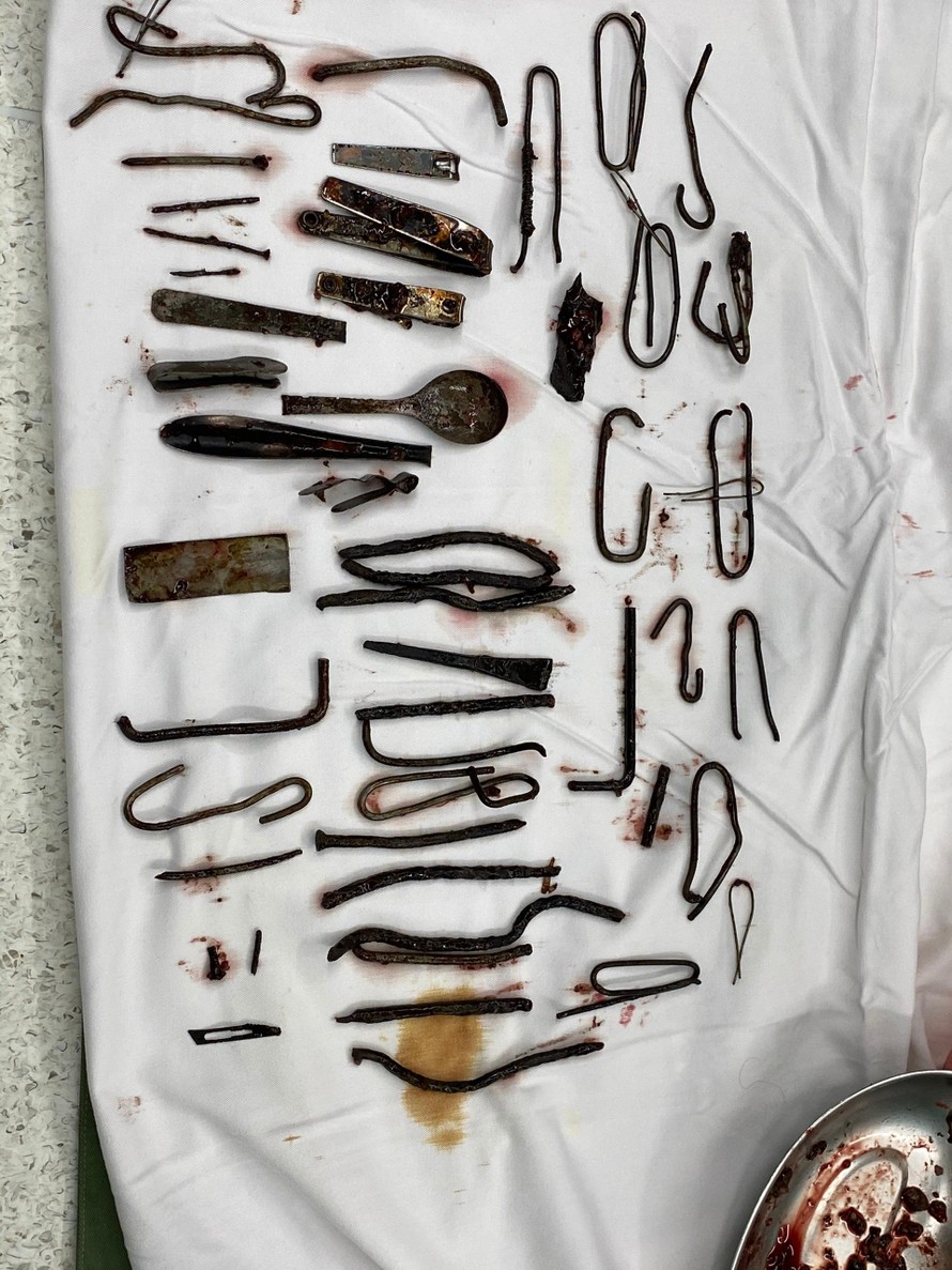 Khoảng 1 kg kim loại được lấy ra từ trong bụng của bệnh nhân. (Ảnh: Sức khoẻ & Đời sống)