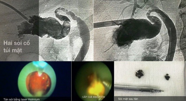 Tin vui cho người bệnh: Tán sỏi túi mật qua da bằng laser