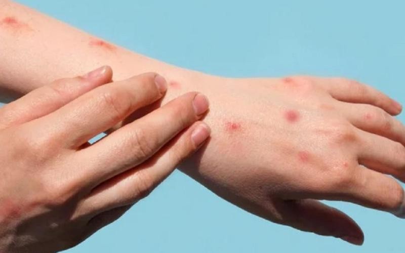 Chủ động giám sát, phát hiện sớm ca bệnh, nguồn lây đậu mùa khỉ