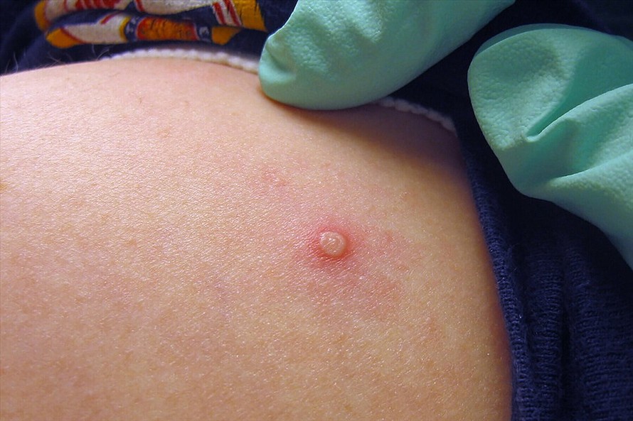 WHO lo ngại nguy cơ lan rộng dịch bệnh đậu mùa khỉ