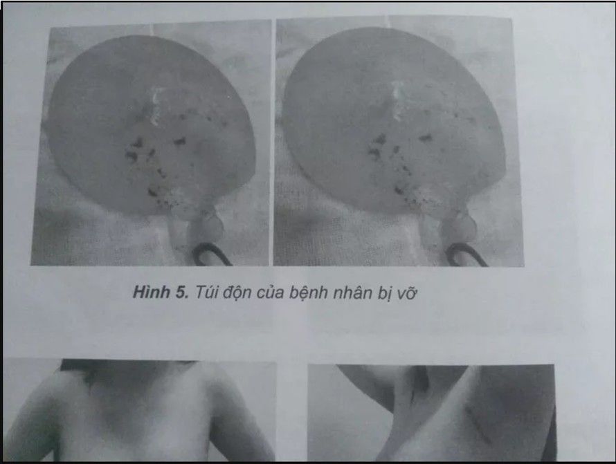 Túi độn ngực vỡ của nữ bệnh nhân được các sĩ lấy ra