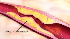 Phát hiện các đặc điểm giống ung thư trong chứng xơ vữa động mạch