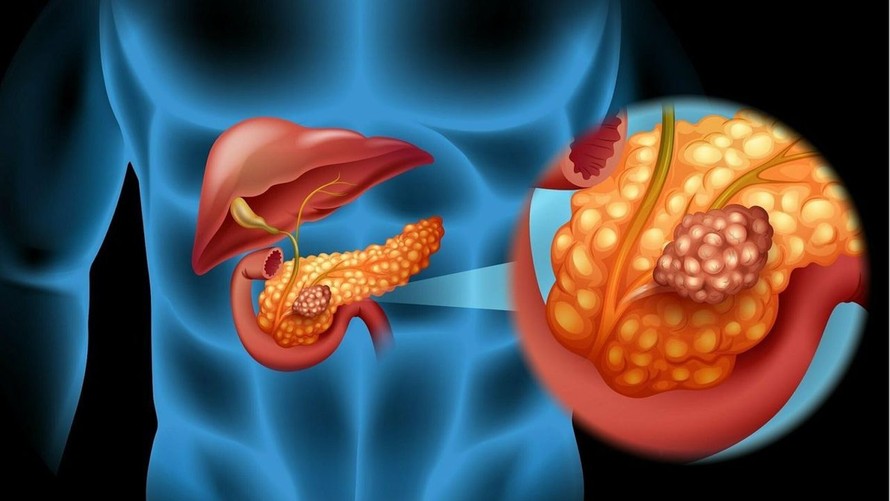 Phương pháp mới giúp phát hiện sớm ung thư tuyến tụy