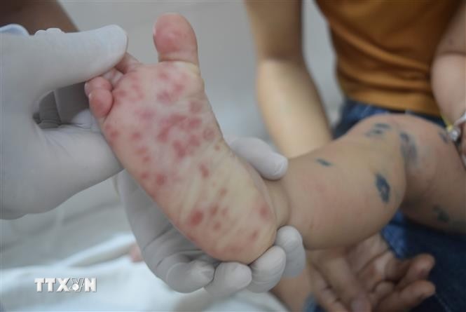 Các nốt phát ban của bệnh nhi bị tay chân miệng. Ảnh: Nguyên Dung/TTXVN.