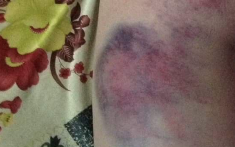 Đắk Lắk: Giáo viên đánh bầm tím mông học sinh lớp 4