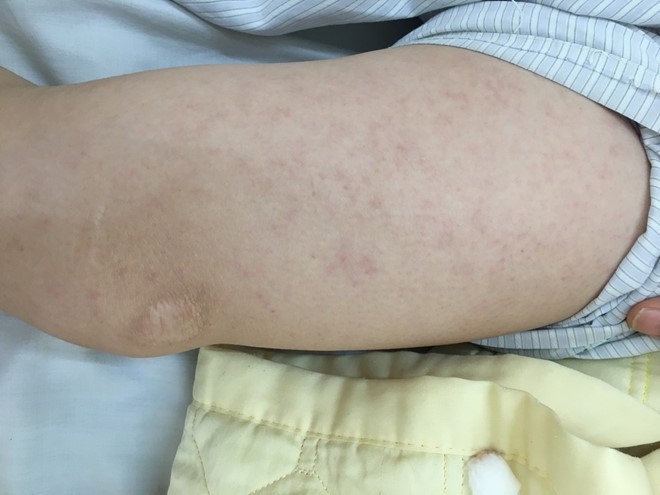 Vết ban đỏ trên người bệnh nhân. Ảnh: BVCC.