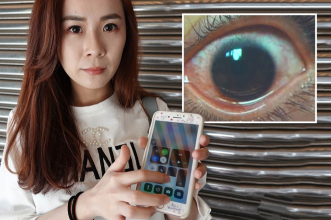 Cô gái bị thủng 500 lỗ trên giác mạc vì không hạ độ sáng màn hình điện thoại. Ảnh: The Sun