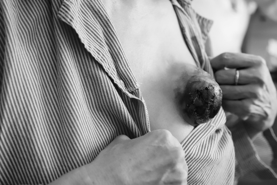 Khối u vú của nữ bệnh nhân phát triển nhanh sau khi không được điều trị kịp thời. - Ảnh: Báo Giao Thông