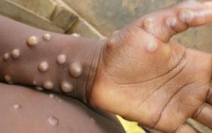 Tăng cường giám sát, phát hiện ca nghi ngờ bệnh đậu mùa khỉ