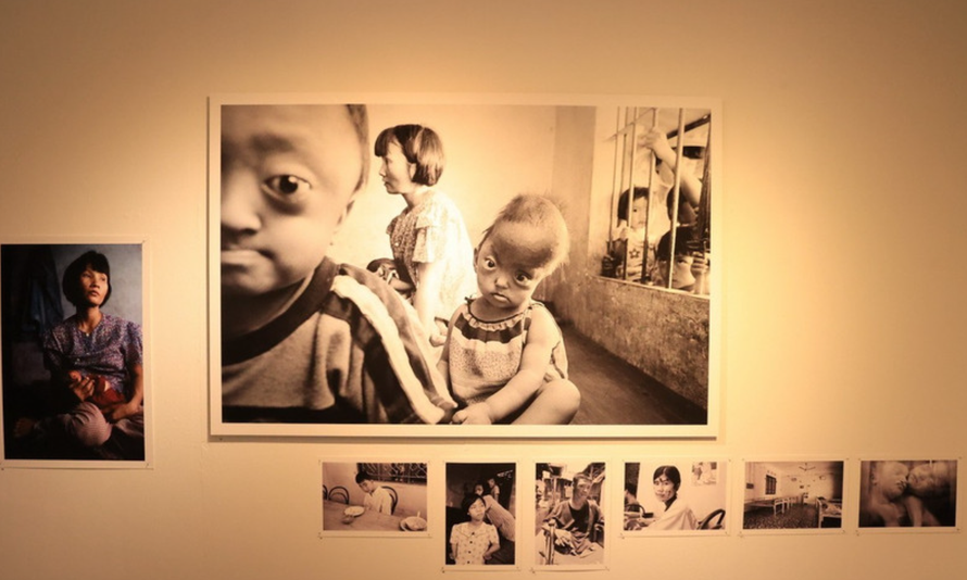 Hình ảnh nạn nhân chất độc màu da cam/dioxin tại Việt Nam.