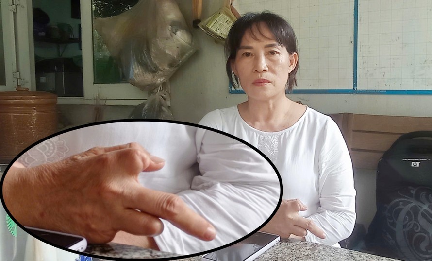 Chị Nguyễn Thị Phương Liên và bàn tay bị dị tật do tai nạn lao động.