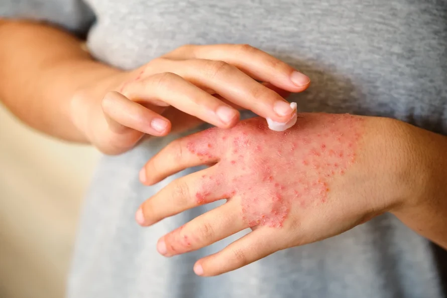 Chăm sóc da vào thời tiết hanh khô: Lời khuyên từ các chuyên gia
