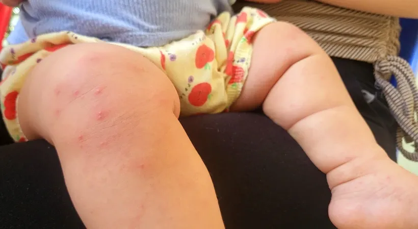 Một bệnh nhi mắc bệnh tay chân miệng với nhiều nốt ban. Ảnh: TTXVN.