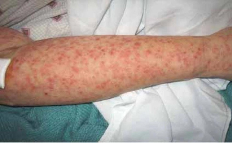 Dịch sốt Chikungunya lây lan tại thành phố Phật Sơn, Trung Quốc