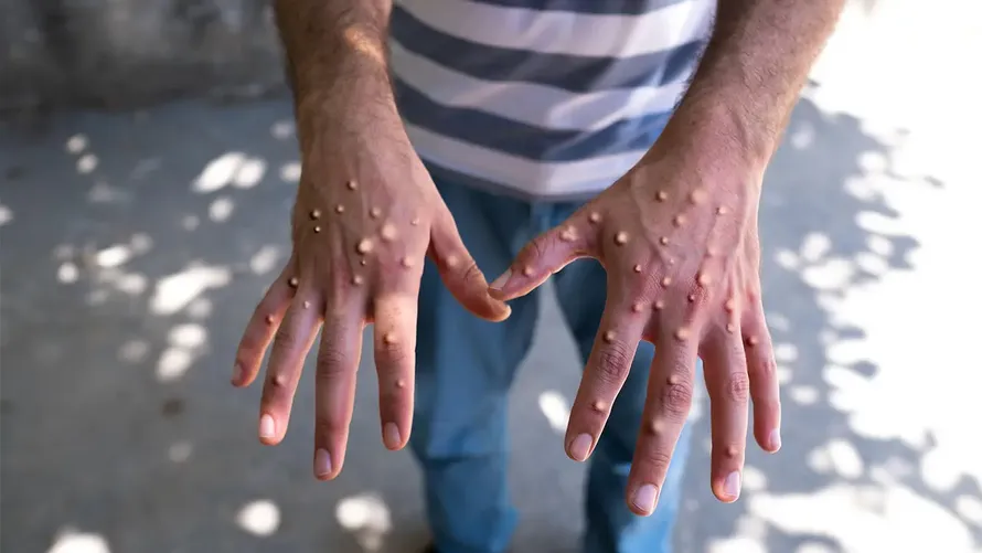 Bệnh nhân mắc đậu mùa khỉ ở châu Phi. 