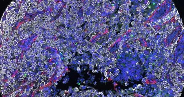 Giải bài toán “tàng hình” của tế bào ung thư